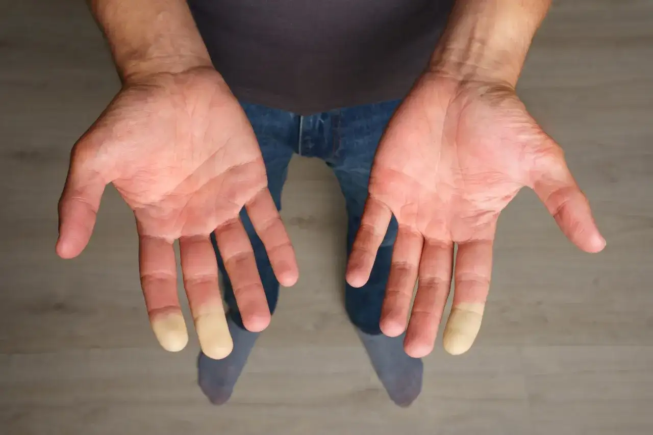 Stałe marznięcie - kiedy to anemia, tarczyca albo Raynaud?
