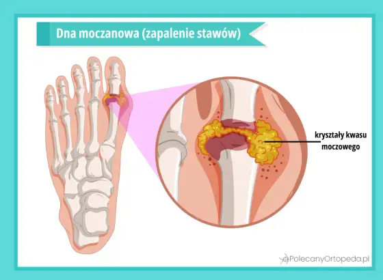 Soda a dna moczanowa - kiedy naprawdę ma sens?